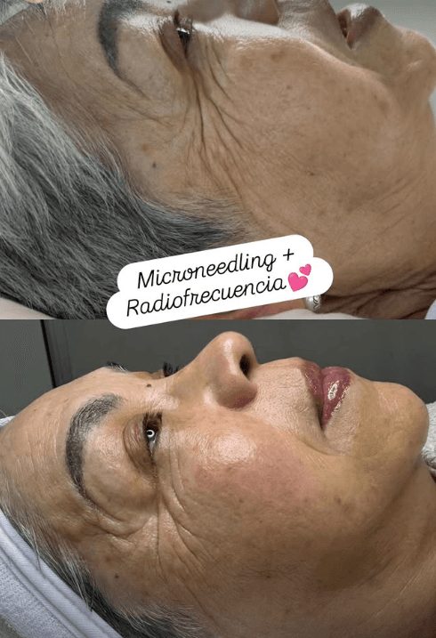 Tratamiento facial combinado de microneedling y radiofrecuencia